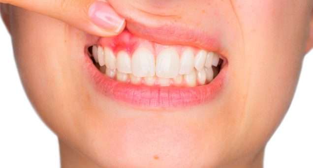 enfermedad periodontal tratamiento
