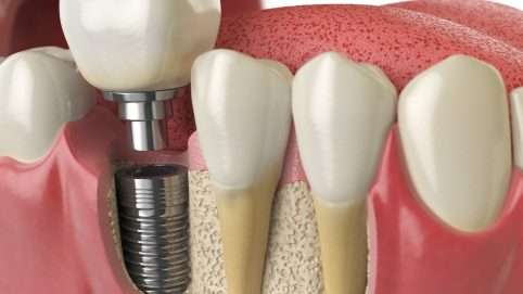 implantes dentales en Barcelona