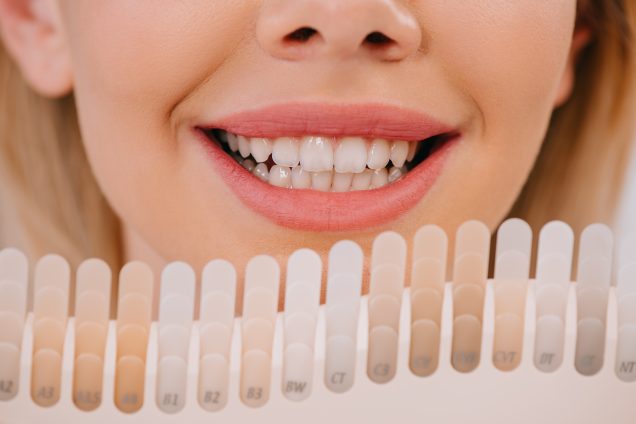 Carillas dentales